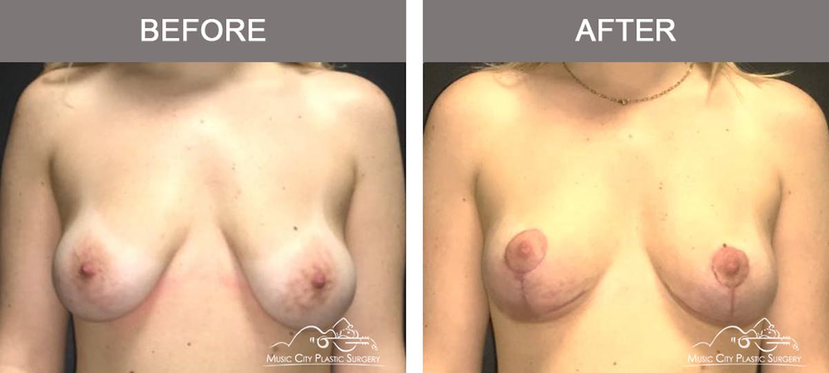 Breast Lift Before & After Gallery - Patient 259530 - Image 1