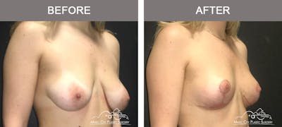 Breast Lift Before & After Gallery - Patient 259530 - Image 2