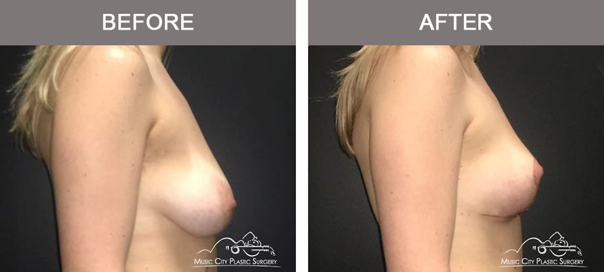Breast Lift Before & After Gallery - Patient 259530 - Image 3