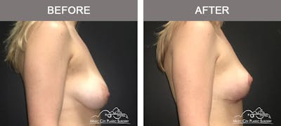 Breast Lift Before & After Gallery - Patient 259530 - Image 3