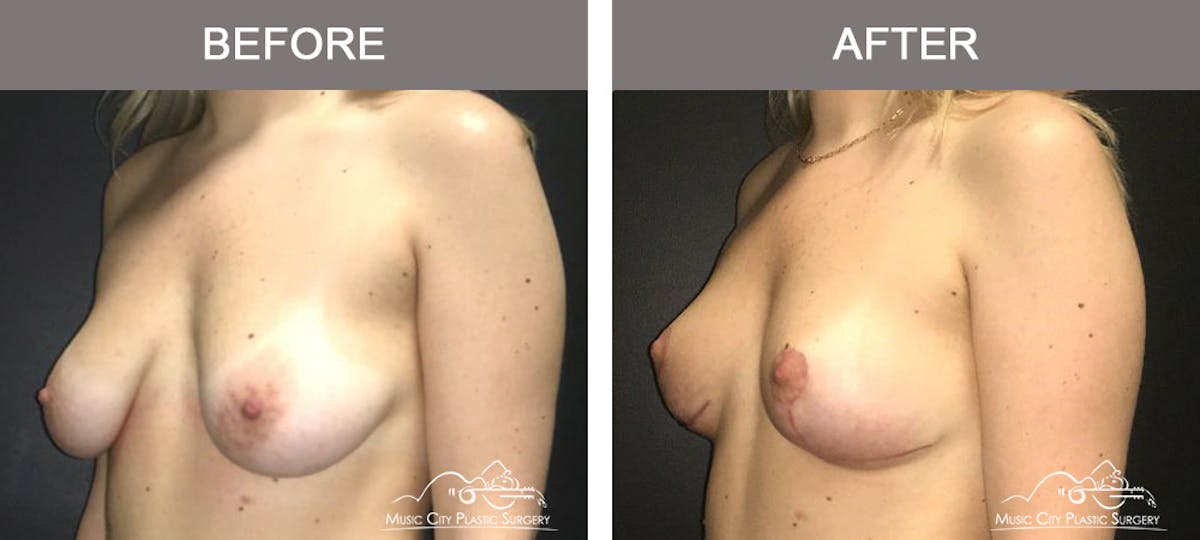 Breast Lift Before & After Gallery - Patient 259530 - Image 4
