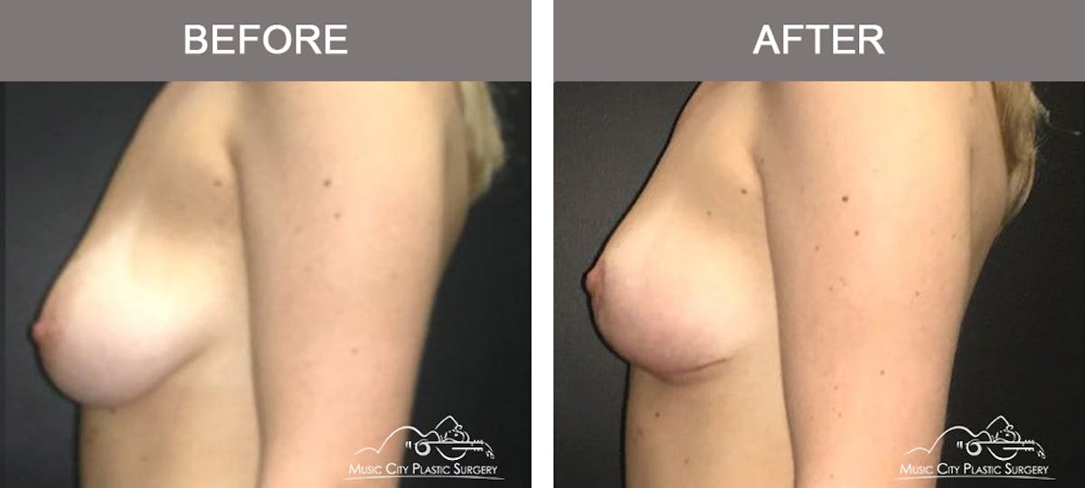 Breast Lift Before & After Gallery - Patient 259530 - Image 5