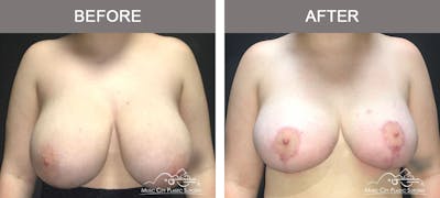 Breast Lift Before & After Gallery - Patient 421119 - Image 1