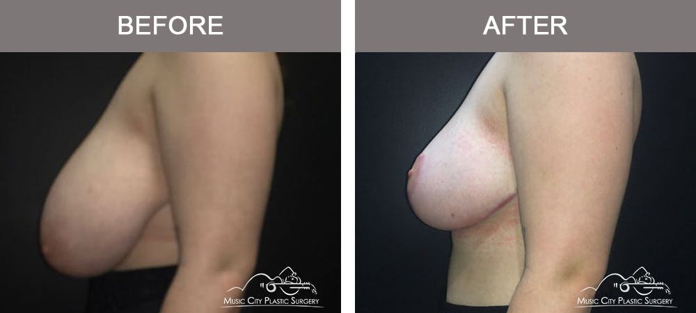 Breast Lift Before & After Gallery - Patient 421119 - Image 3