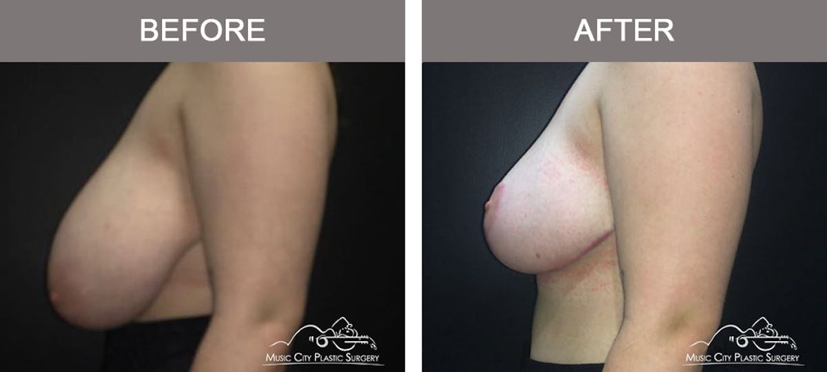 Breast Lift Before & After Gallery - Patient 421119 - Image 3
