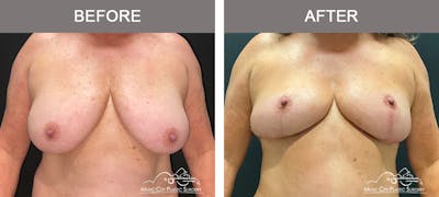 Breast Lift Before & After Gallery - Patient 333855 - Image 1