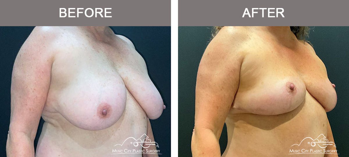 Breast Lift Before & After Gallery - Patient 333855 - Image 2