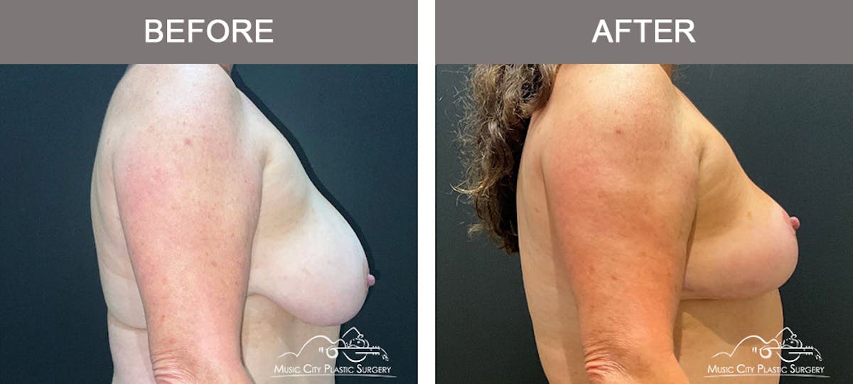 Breast Lift Before & After Gallery - Patient 333855 - Image 3
