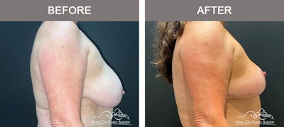 Breast Lift Before & After Gallery - Patient 333855 - Image 3