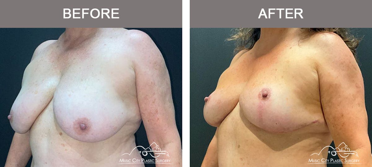 Breast Lift Before & After Gallery - Patient 333855 - Image 4