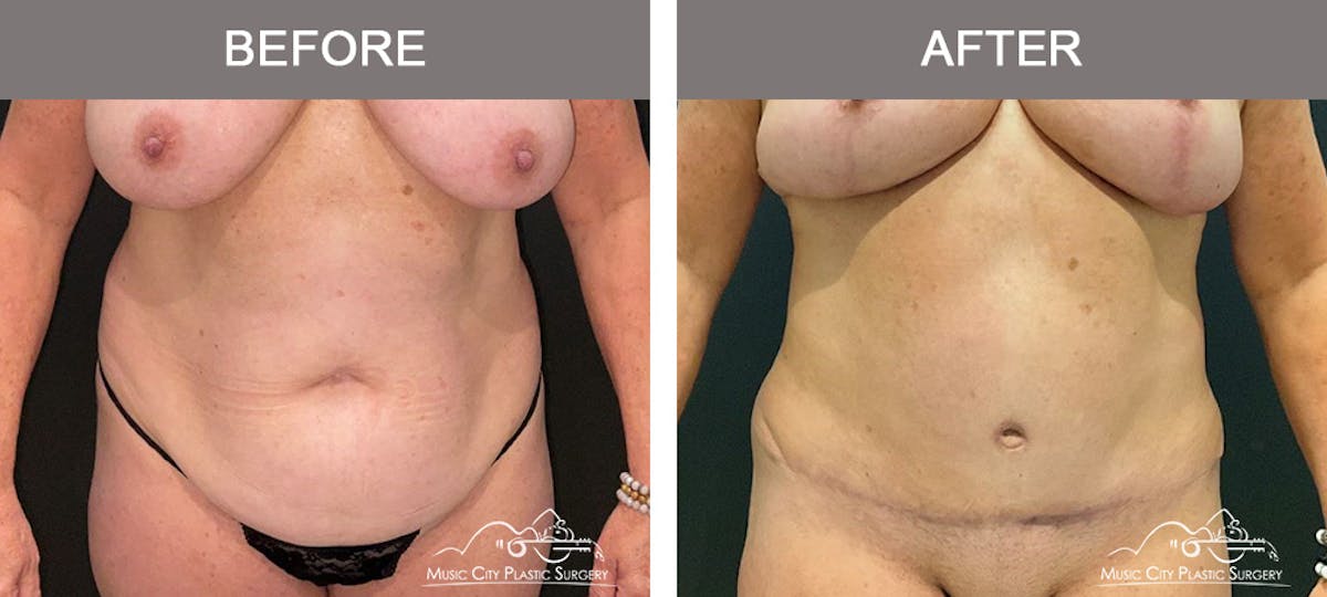 Abdominoplasty Before & After Gallery - Patient 260225 - Image 1