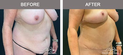 Abdominoplasty Before & After Gallery - Patient 260225 - Image 2