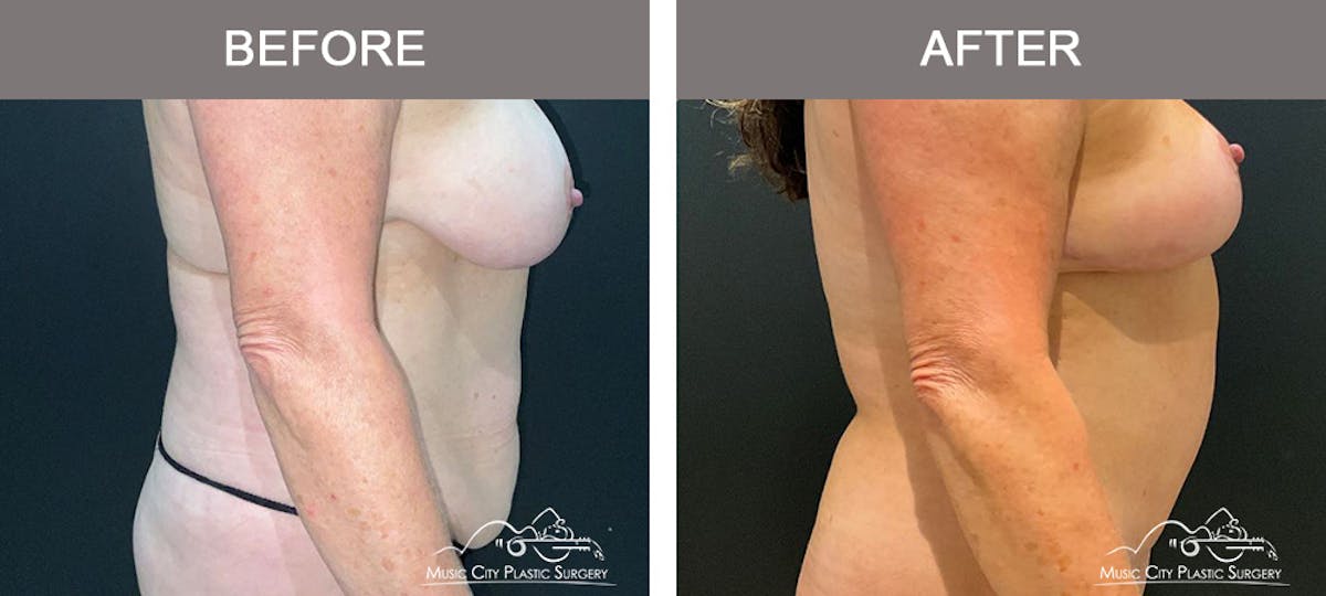Abdominoplasty Before & After Gallery - Patient 260225 - Image 3