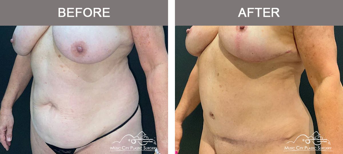 Abdominoplasty Before & After Gallery - Patient 260225 - Image 4