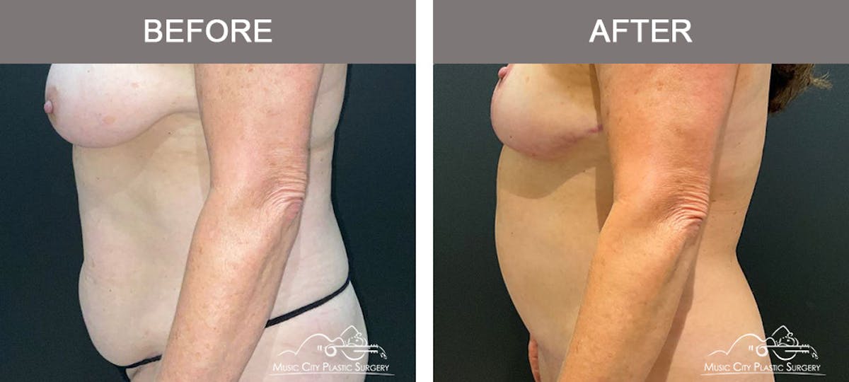 Abdominoplasty Before & After Gallery - Patient 260225 - Image 5