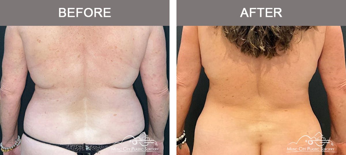 Abdominoplasty Before & After Gallery - Patient 260225 - Image 6