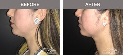 Kybella Before & After Gallery - Patient 130529 - Image 1