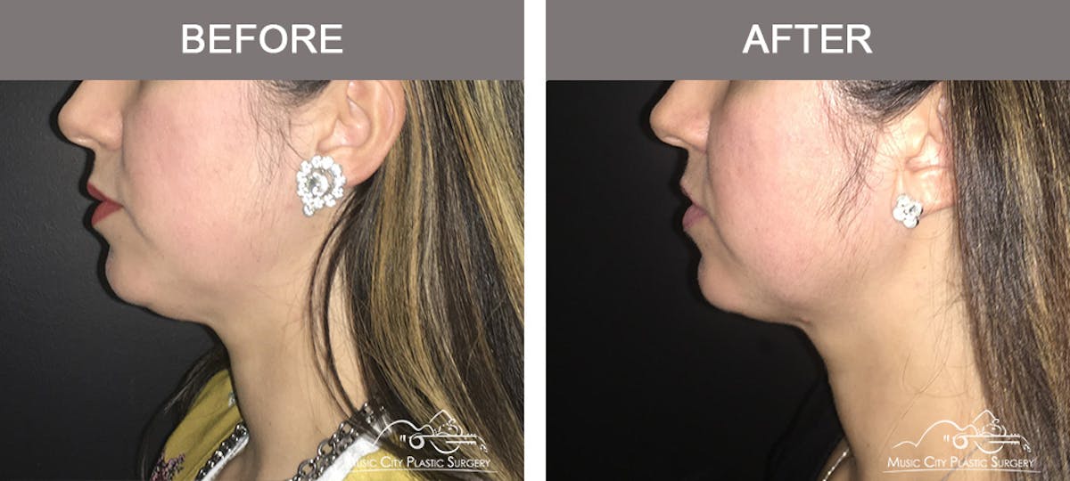 Kybella Before & After Gallery - Patient 130529 - Image 1