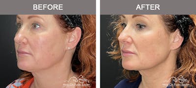 Thread Lifts Before & After Gallery - Patient 267090 - Image 3