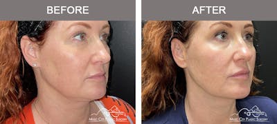 Thread Lifts Before & After Gallery - Patient 267090 - Image 2