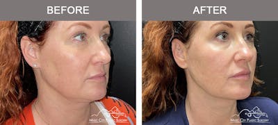 Thread Lifts Before & After Gallery - Patient 267090 - Image 2