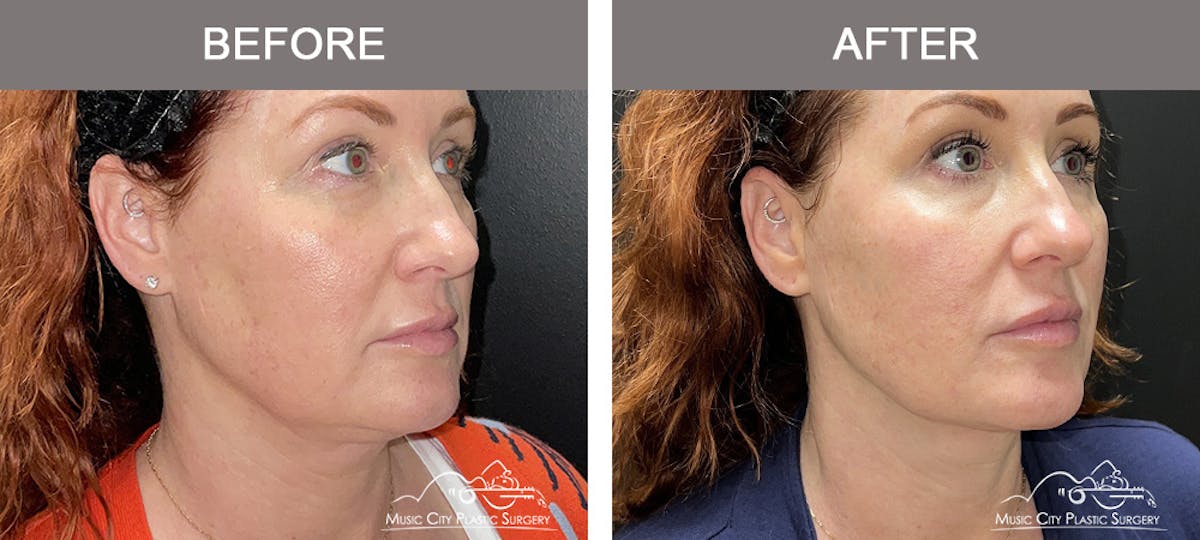 Thread Lifts Before & After Gallery - Patient 267090 - Image 2