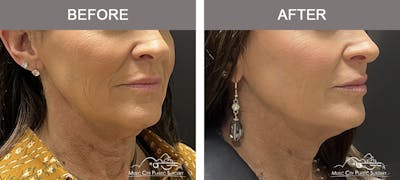 Dermal Fillers Before & After Gallery - Patient 806005 - Image 1