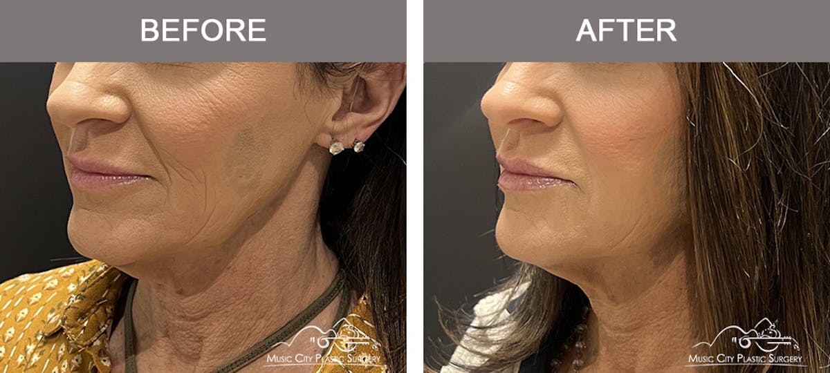 Dermal Fillers Before & After Gallery - Patient 806005 - Image 2