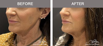 Dermal Fillers Before & After Gallery - Patient 806005 - Image 2