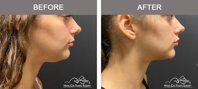 Dermal Fillers Before & After Gallery - Patient 177171 - Image 1