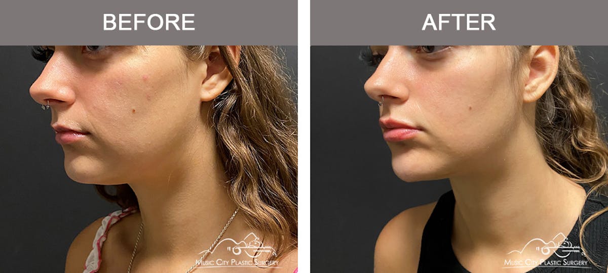 Dermal Fillers Before & After Gallery - Patient 177171 - Image 2
