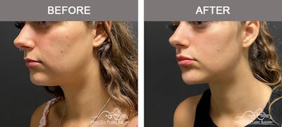 Dermal Fillers Before & After Gallery - Patient 177171 - Image 2