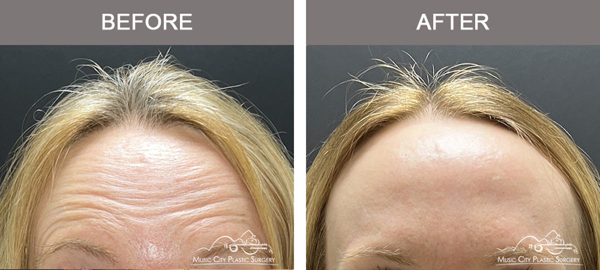 Dysport or Botox Before & After Gallery - Patient 310341 - Image 1