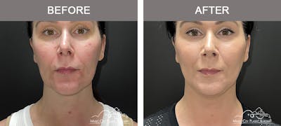 Thread Lifts Before & After Gallery - Patient 377984 - Image 1