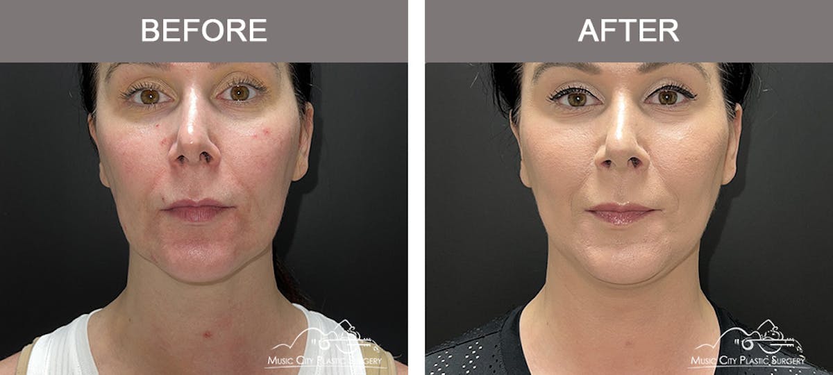 Thread Lifts Before & After Gallery - Patient 377984 - Image 1