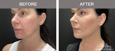 Thread Lifts Before & After Gallery - Patient 377984 - Image 2