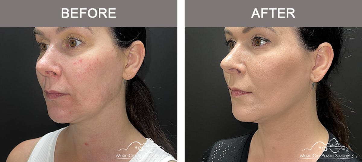 Thread Lifts Before & After Gallery - Patient 377984 - Image 2