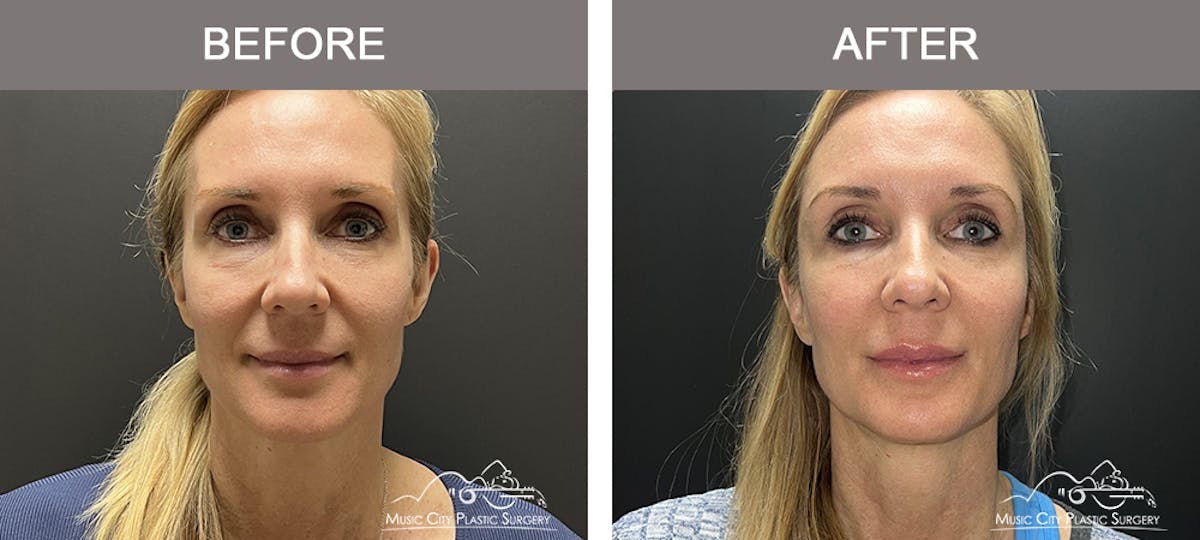 Dermal Fillers Before & After Gallery - Patient 208413 - Image 1