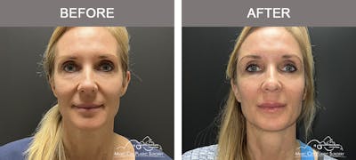 Dermal Fillers Before & After Gallery - Patient 208413 - Image 1