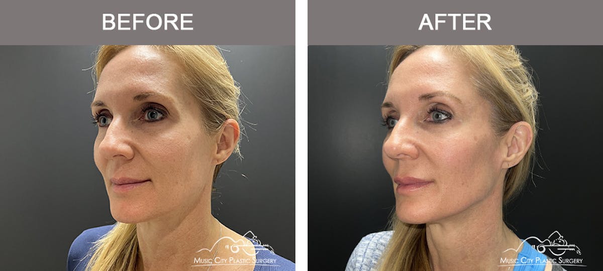 Dermal Fillers Before & After Gallery - Patient 208413 - Image 3