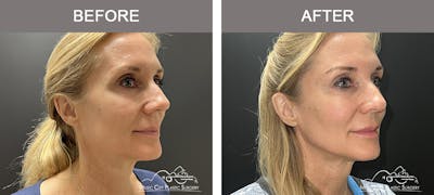 Dermal Fillers Before & After Gallery - Patient 208413 - Image 2