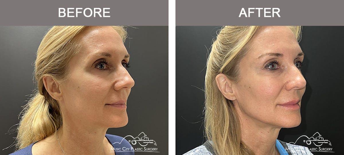 Dermal Fillers Before & After Gallery - Patient 208413 - Image 2