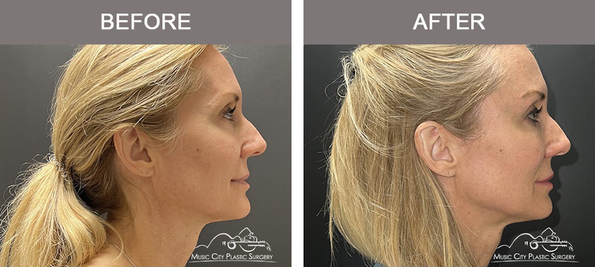 Dermal Fillers Before & After Gallery - Patient 208413 - Image 4