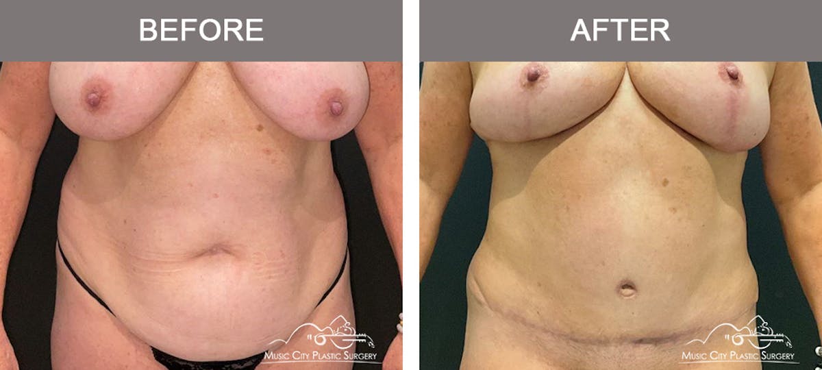 Liposuction Before & After Gallery - Patient 510348 - Image 1
