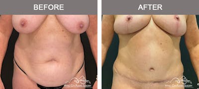 Liposuction Before & After Gallery - Patient 510348 - Image 1