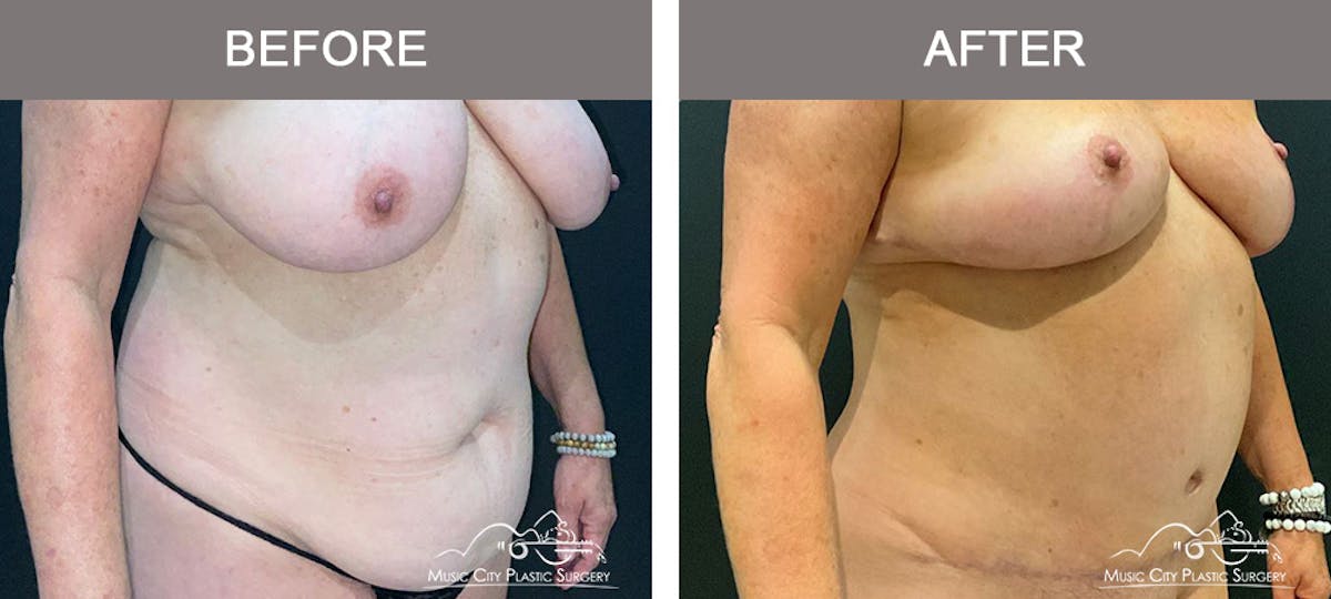 Liposuction Before & After Gallery - Patient 510348 - Image 2