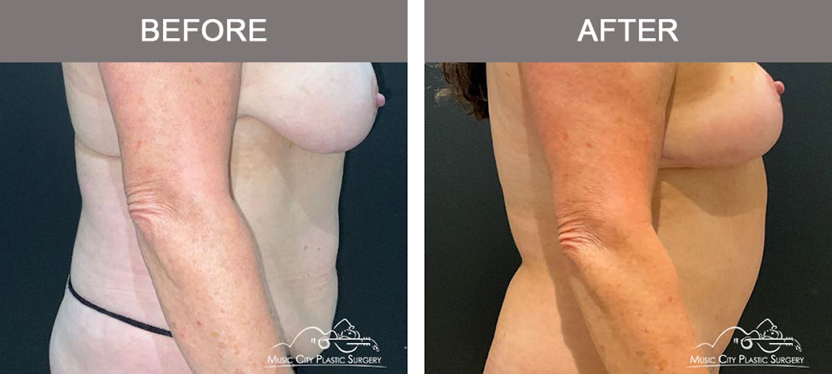 Liposuction Before & After Gallery - Patient 510348 - Image 3
