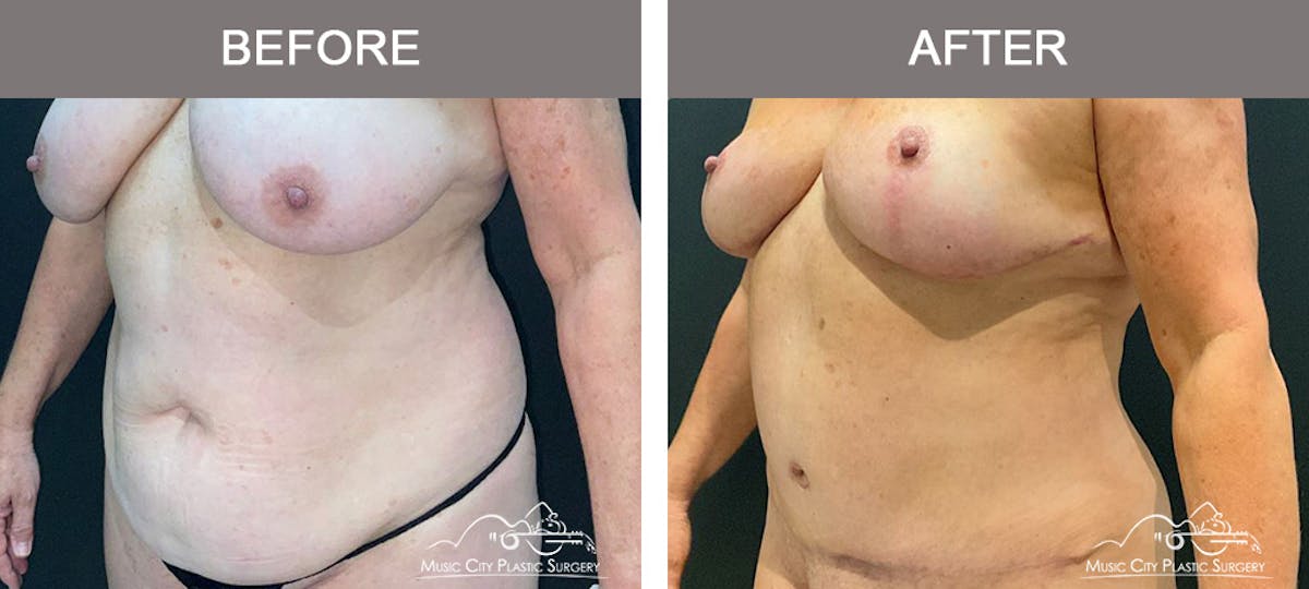 Liposuction Before & After Gallery - Patient 510348 - Image 4