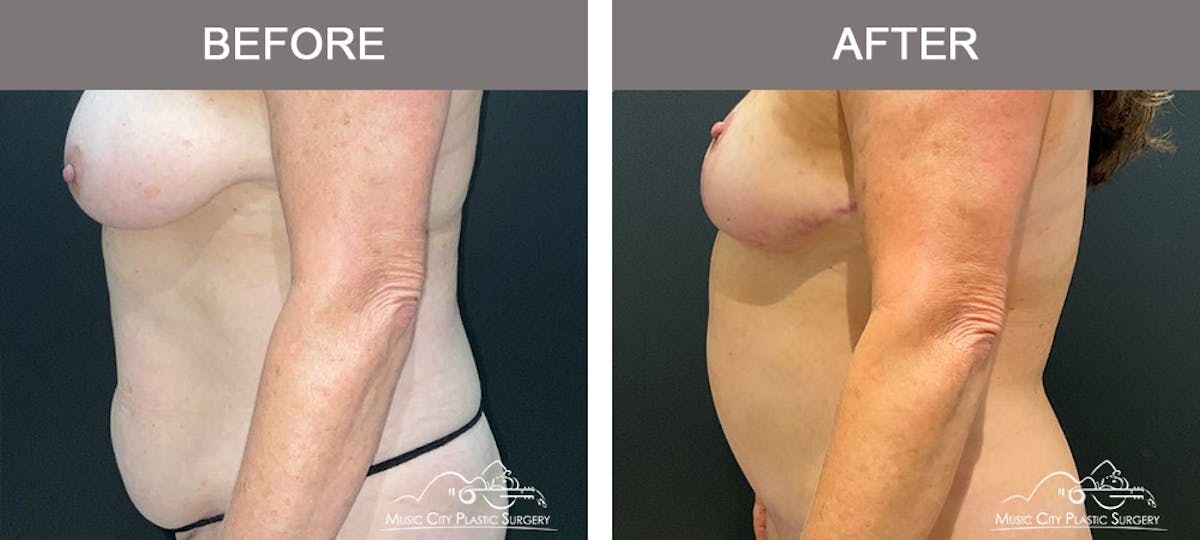 Liposuction Before & After Gallery - Patient 510348 - Image 5