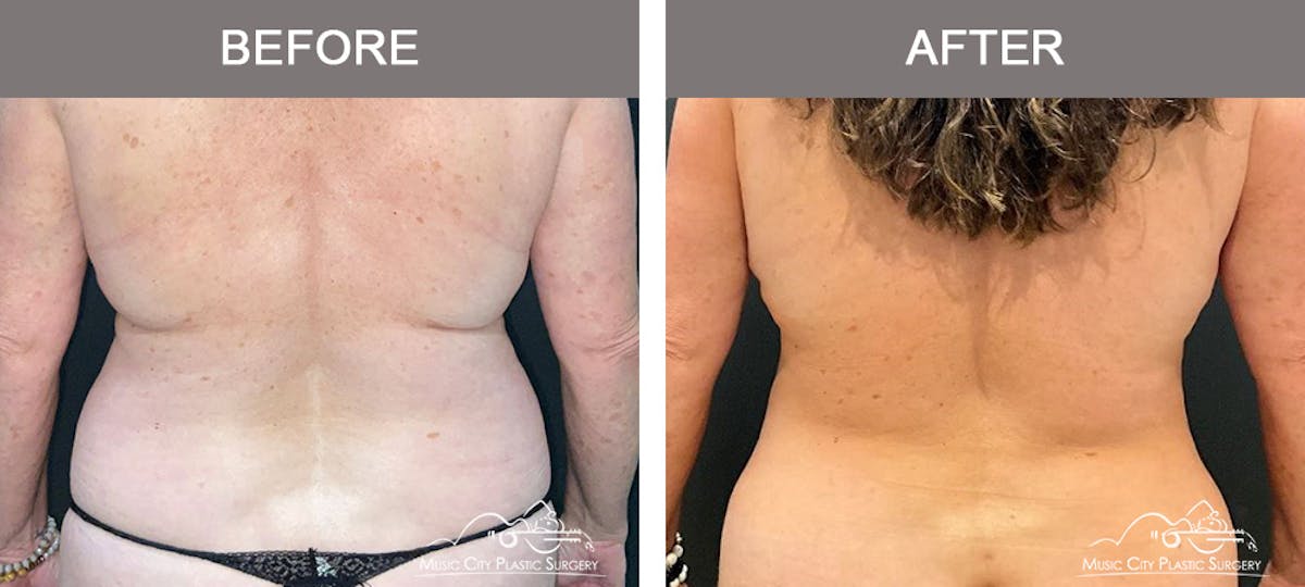 Liposuction Before & After Gallery - Patient 510348 - Image 6